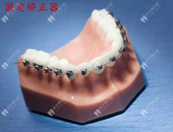 兒童金屬固定矯正器