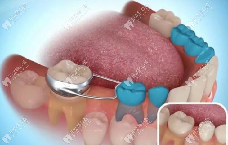 牙齿间隙保持器示意图