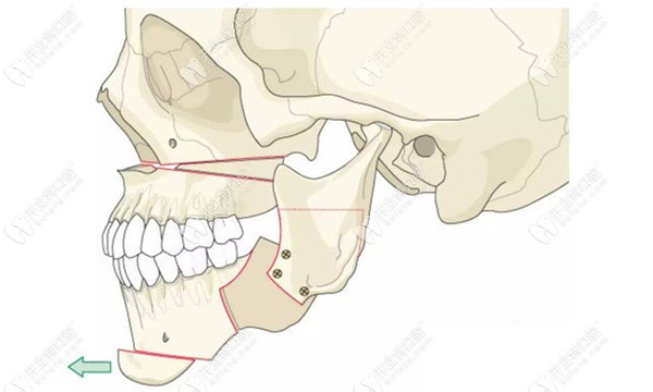 凸嘴手术和正颌手术区别