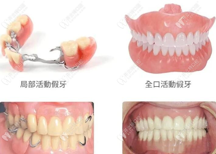 牙齿缺失修复方法：种植牙、活动假牙