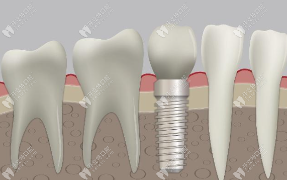小诊所种植牙并不靠谱