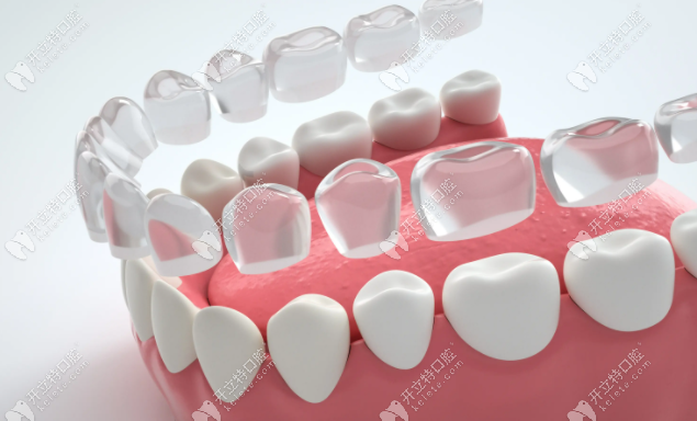 牙齿矫正常见的技术