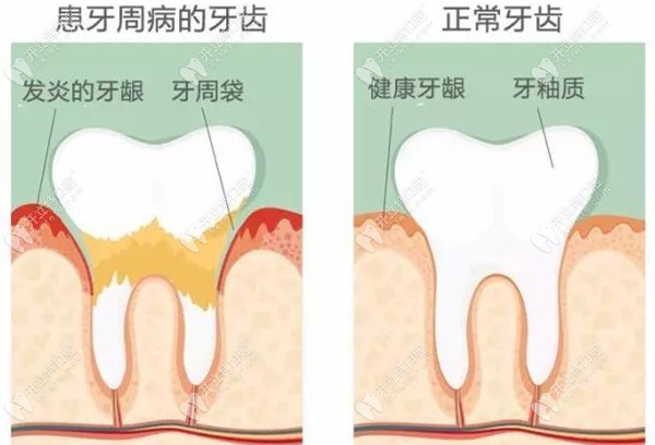 牙周病牙齿与正常牙齿对比