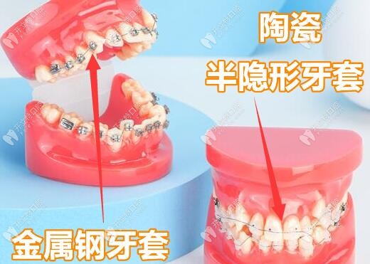 牙齿矫正器：金属牙套和陶瓷托槽