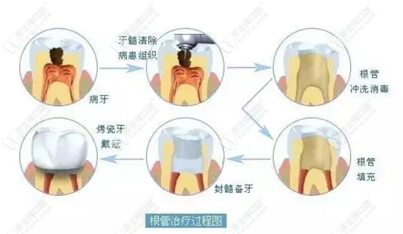 这是根管治疗全过程