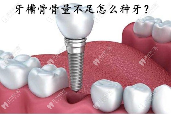 富纤维蛋白粘骨术：牙槽骨骨量不足的新处理技术
