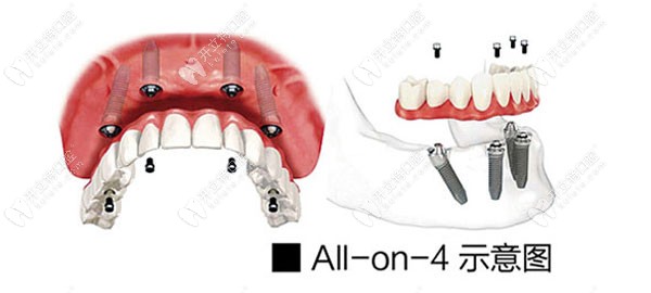 希美口腔allon-4M速导种植牙
