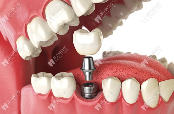 石家庄全博口腔种植牙价格
