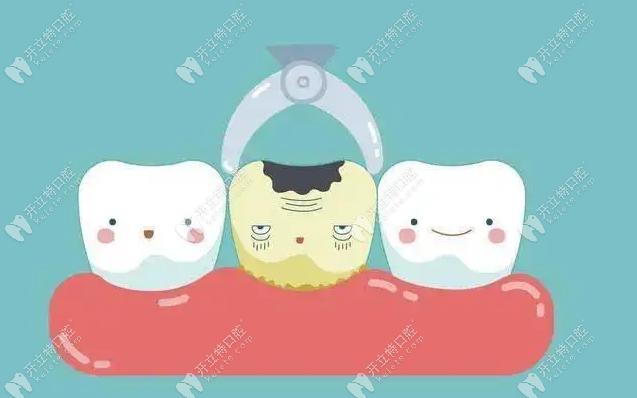 为什么医生都不建议微创拔牙,是因为微创拔牙拔不干净吗