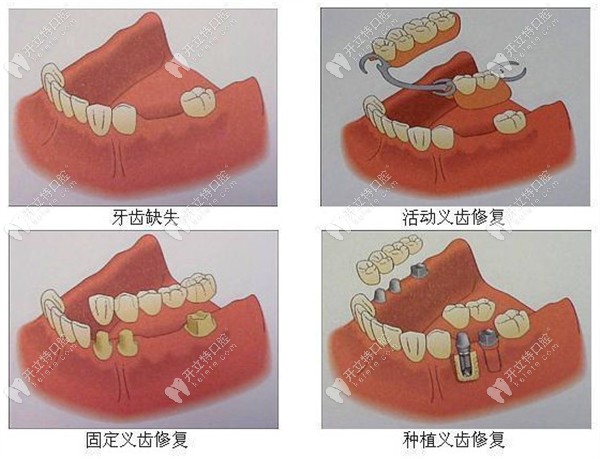 南昌红谷滩中卓口腔义齿修复