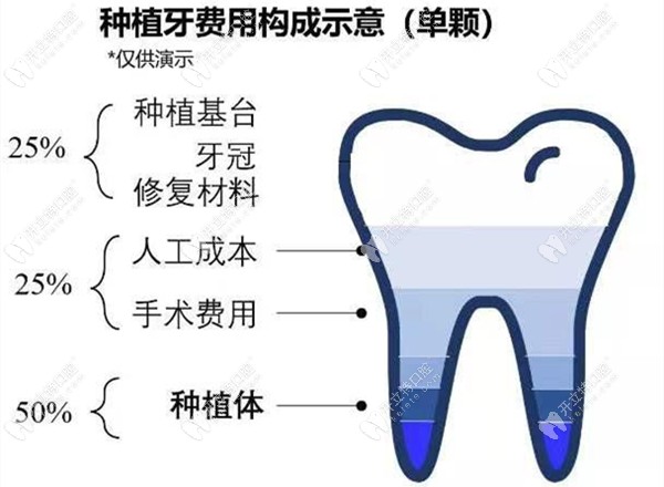 集采后的国产和进口种植牙收费标准