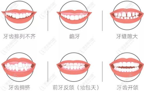 需做牙齿矫正的错颌畸形