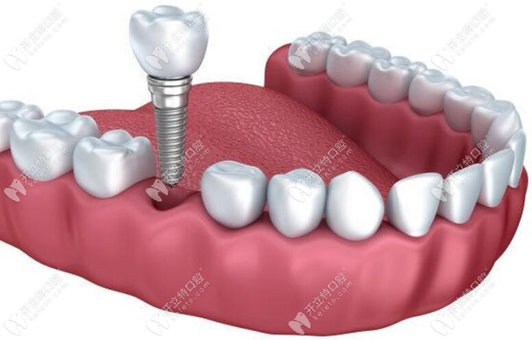 单颗即刻种植牙www.kelete.com