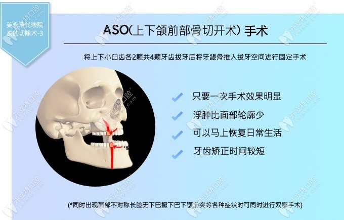 ASO（上下颌前部骨切开术）手术介绍
