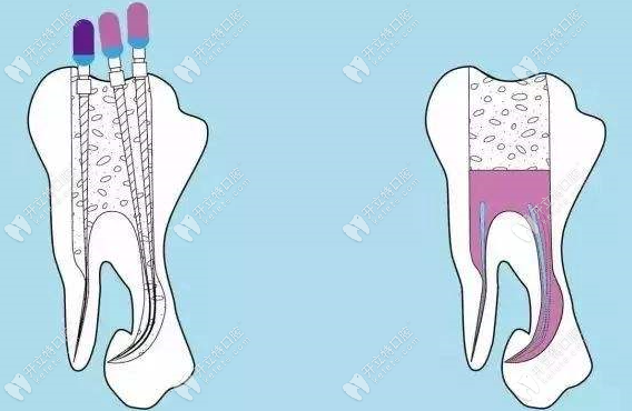 根管治疗中冷牙胶和热牙胶优缺点对比,看完就知哪个好