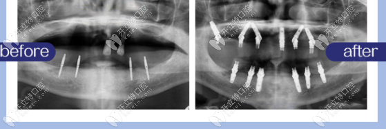 植贝尔口腔种植病例前后对比图
