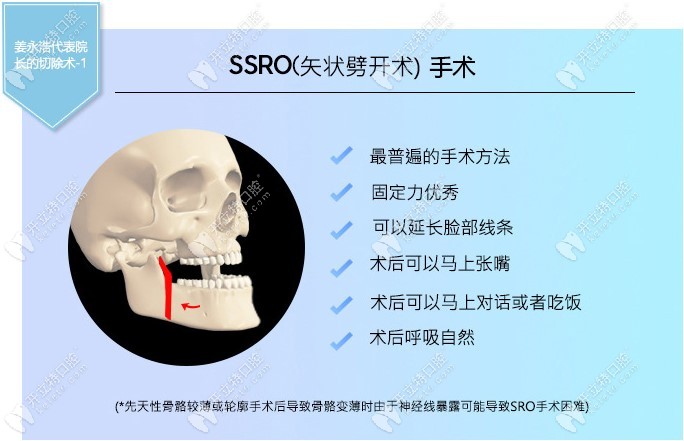 SSRO(矢状劈开）手术特点