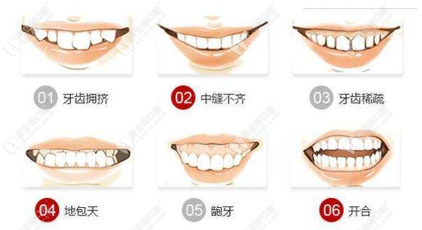 牙齿错颌畸形的各种病例