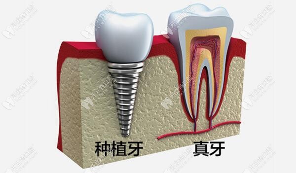 韩国进口种植牙价格下调至3999元起一颗