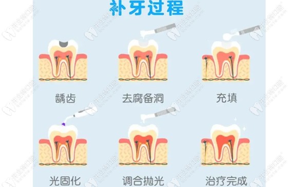 补牙的过程图片