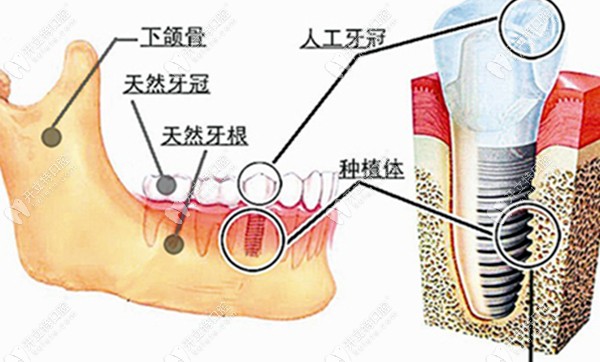 种植体在牙骨内的图