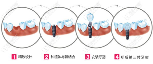 德国骨速生种植牙技术优势:缩短种植周期/加快伤口愈合速度