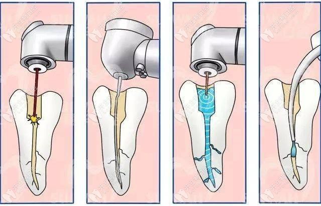 牙齿根管治疗步骤图片