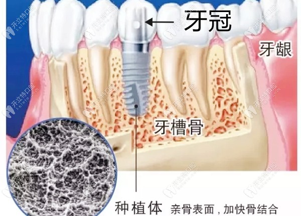 种植牙在牙槽骨内的图