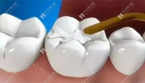 闽侯瑞尔齿科的进口树脂补牙费用