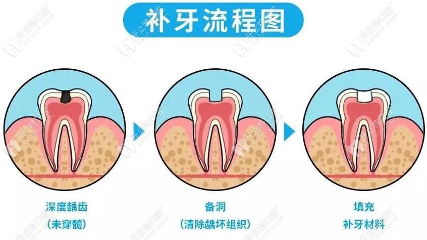 补牙流程图