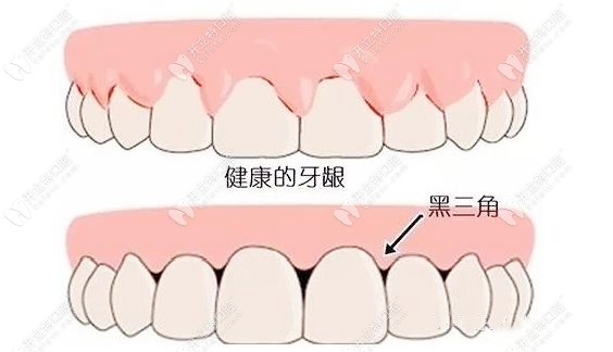 牙齿黑三角形成的原因有哪些？牙周炎/牙列拥挤都有关系