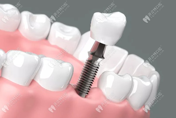 贝臣口腔骨速生种植牙技术可以缩短种植周期加快骨结合哦