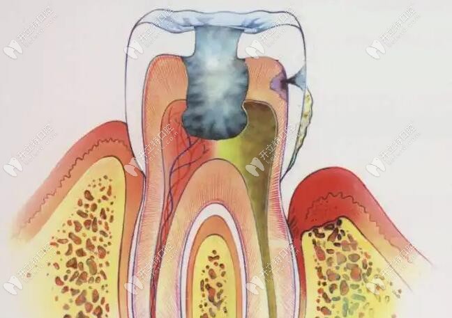 解答牙髓炎症状有哪些以及急性牙髓炎的应急处理方法