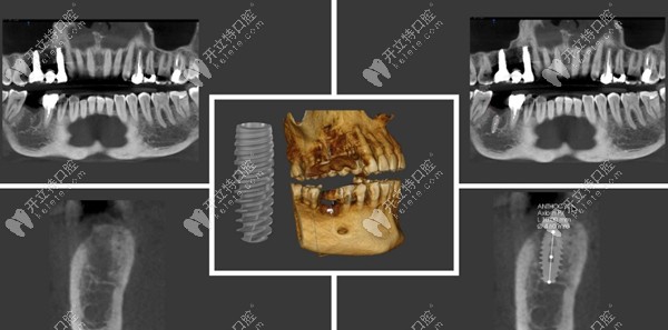 安卓健种植体植入牙槽骨中的全景片