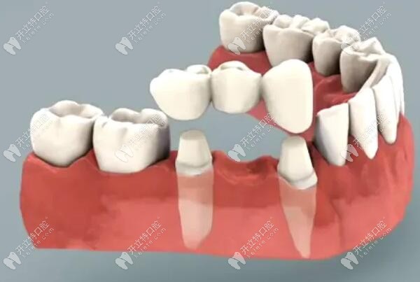 掉1颗牙为什么要做3颗牙冠呢?缺失1颗牙做3连桥的利弊及原因