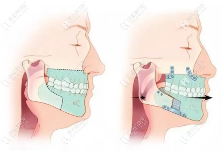 南京正颌手术费用一般多少钱?含骨性凸嘴/龅牙/地包天价格