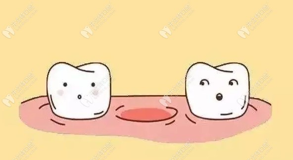 缺几颗牙要种几颗吗？