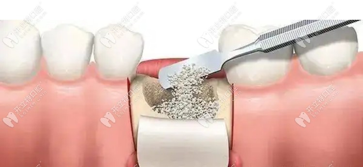 种植牙骨粉骨膜的作用