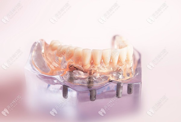 全口ALLON4种植牙技术