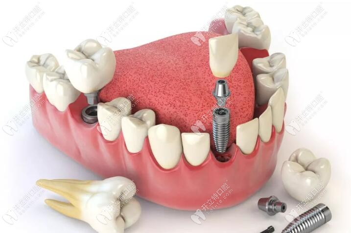 大剂量服用抗凝药顾客做种植牙是有风险的