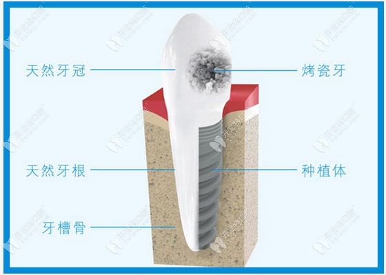 人工种植牙的结构