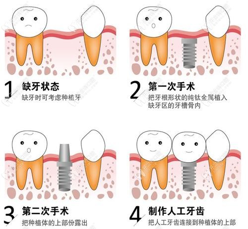 种植牙种植过程