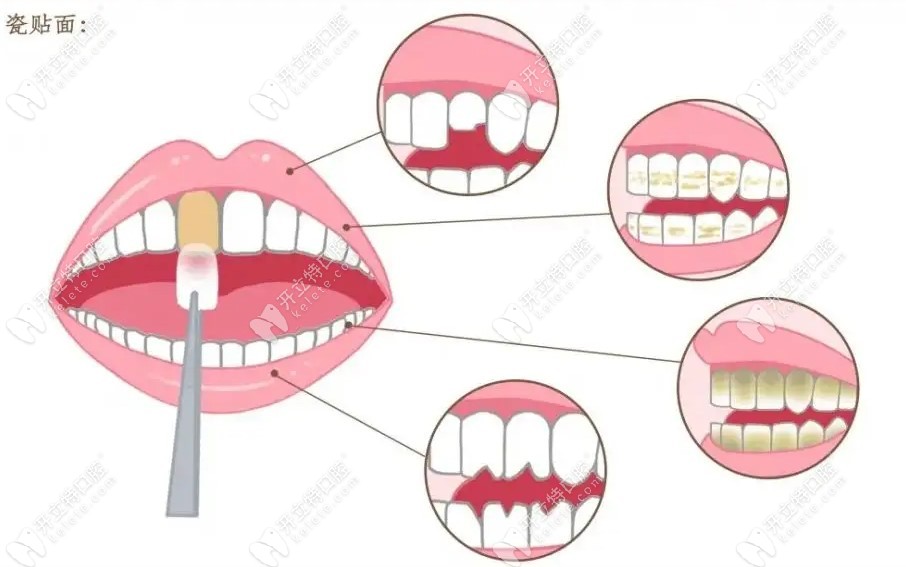牙贴面大概可以维持多久,是保持几年时间还是能用一辈子？