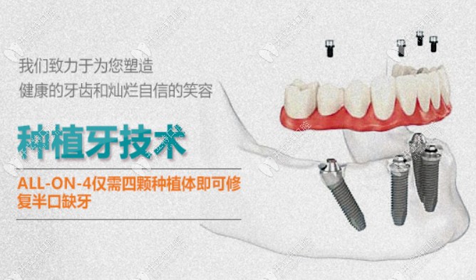 南京美奥口腔的Allon4种植牙技术