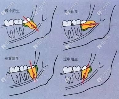 阻生智齿牙类型