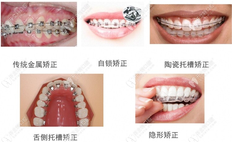 陈祥宙医生可做的牙齿矫正器