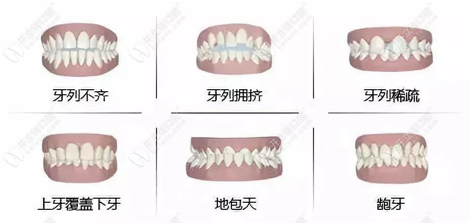 陈祥宙医生可改善的牙齿畸形症状