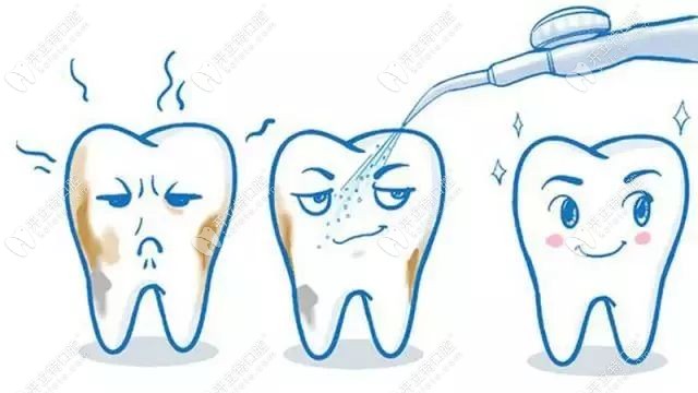 泉州安溪泉兴口腔超声波洗牙