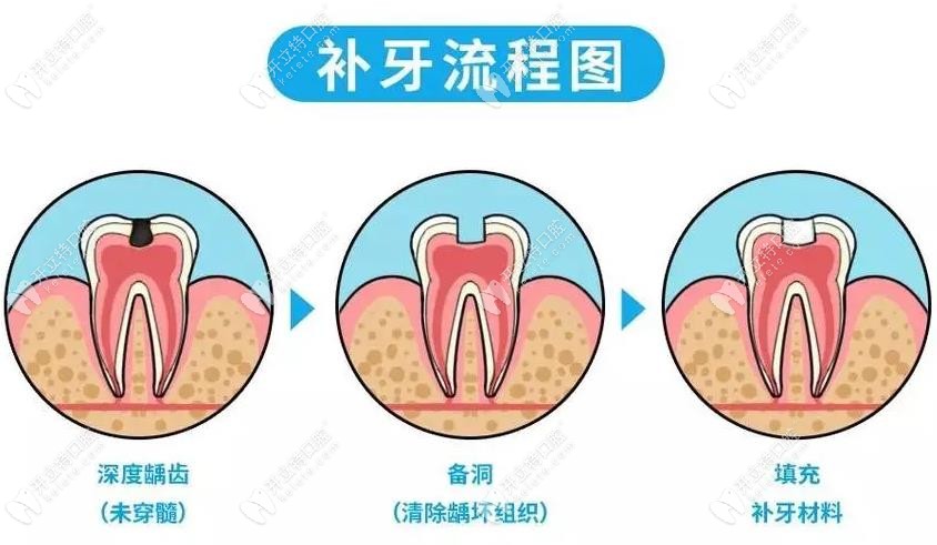 長(zhǎng)治艾美萊口腔補(bǔ)牙流程