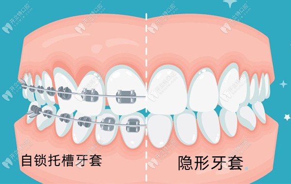 臨汾堯都清舒口腔矯治器